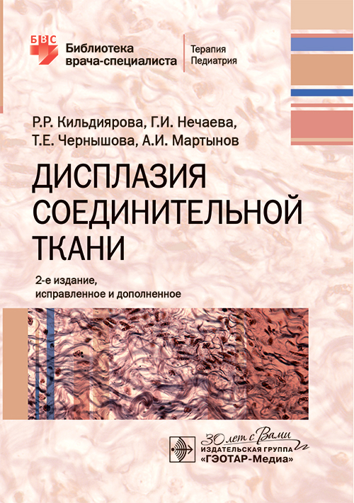 Дисплазия соединительной ткани