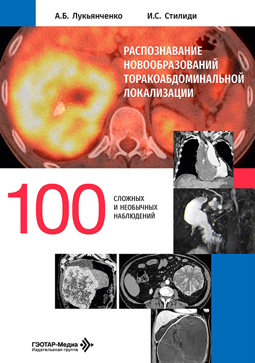 Распознавание новообразований торако-абдоминальной локализации. 100 сложных и необычных наблюдений (читать на сайте эл.версию)
